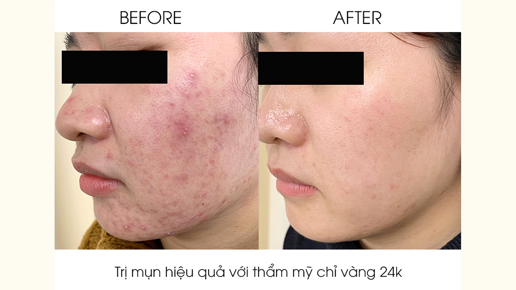 Liệu Pháp Thẩm Mỹ Chỉ Vàng Tái Sinh Làn Da 24k