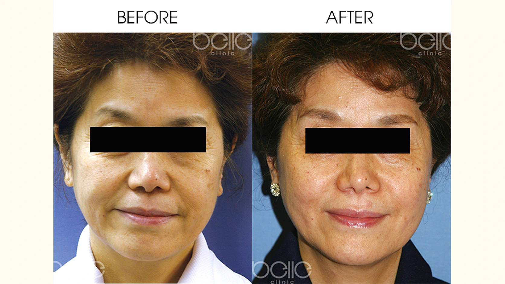 Liệu Pháp Thẩm Mỹ Chỉ Vàng Tái Sinh Làn Da 24k